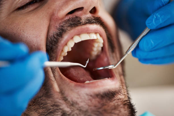 Best Dentist for Tooth Abscess  in Seat Pleasant, MD